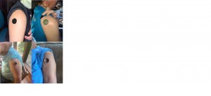 Demonstration of neodymium magnet attachment to the skin on 4 Subjects