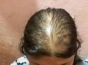 Various Ways of Treating of Hair Pattern Baldness in Females?