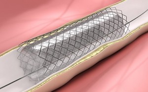 Carotid Stent Market
