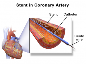 Coronary Stents Market