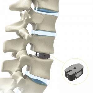 spinal implants