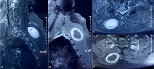 MRI of the spinal tumor.