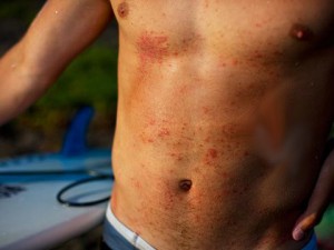 Example of Skin Rash