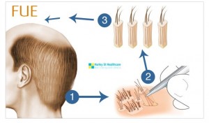Fue Hair Transplant Harley Street