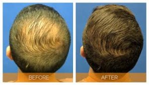 Fue Hair Transplant