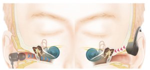 Normal Headphones Vs WeHear OX