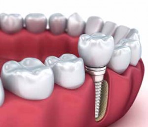 dental implants