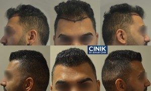 Affordable Hair Transplant in Turkey at Dr Cinik’s Clinic