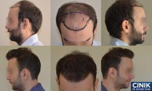 Affordable Hair Transplant in Turkey at Dr Cinik’s Clinic