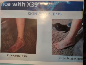 Foot cut and heal by X39 