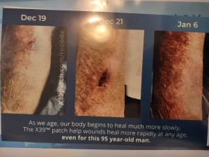 Infected leg healed again with X39 patch