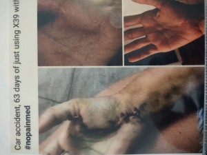 Mans deceased foot healed by using X39 Infrared healing patch in weekes