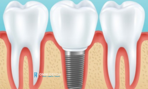 Dental Implants McMurray