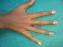 Hand Surgeon in Kolkata Hand Surgeon in Kolkata