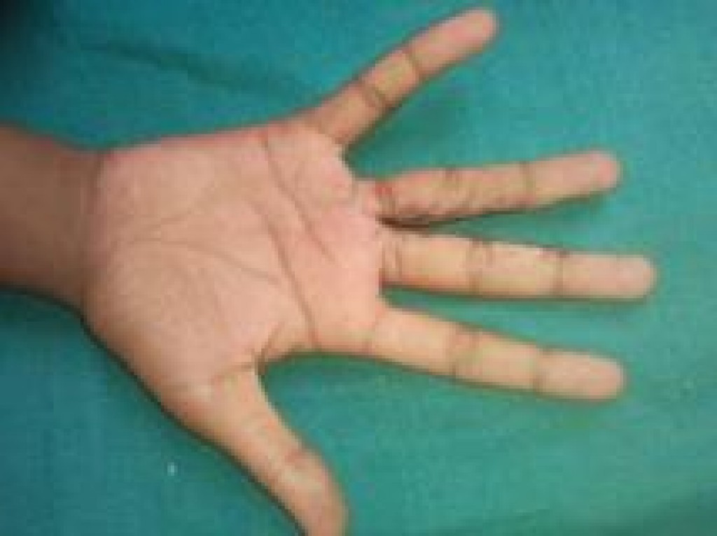 Hand Surgery Kolkata Hand Surgery Kolkata