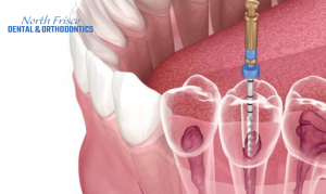 root canal treatment