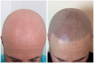 scalp micro pigmentation shaved effect result02