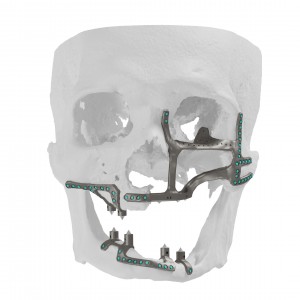 Maxillary Reconstruction using EZ Recon