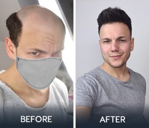 hair system tranformation-New Times Hair