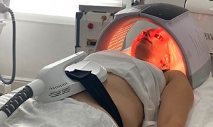 Body Sculpting Laser Treatment