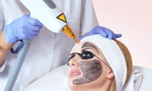carbon laser facial