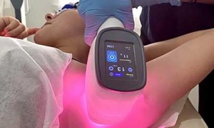 diode laser hair removal