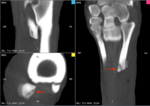 Imaging an axial fracture of proximal MTIV of right rear limb of a 2-year-old QH.