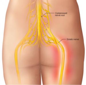 Sciatica SOS™ A 2000-Year-Old Nepalese Trick to A Sciatica Free Life – GUARANT