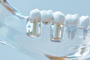 Dental Implants