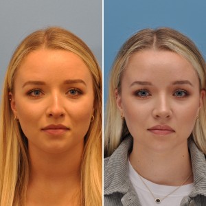 Female Rhinoplasty Patient- Frontal