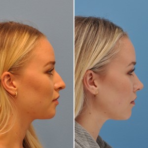 Female Rhinoplasty Patient- Side Profile