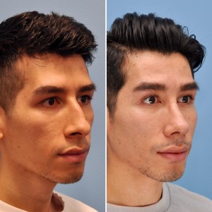 Male Rhinoplasty Patient- Oblique