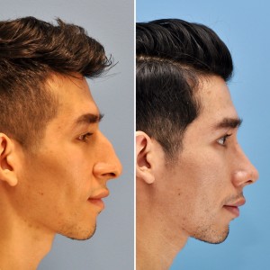 Male Rhinoplasty Patient- Side Profile