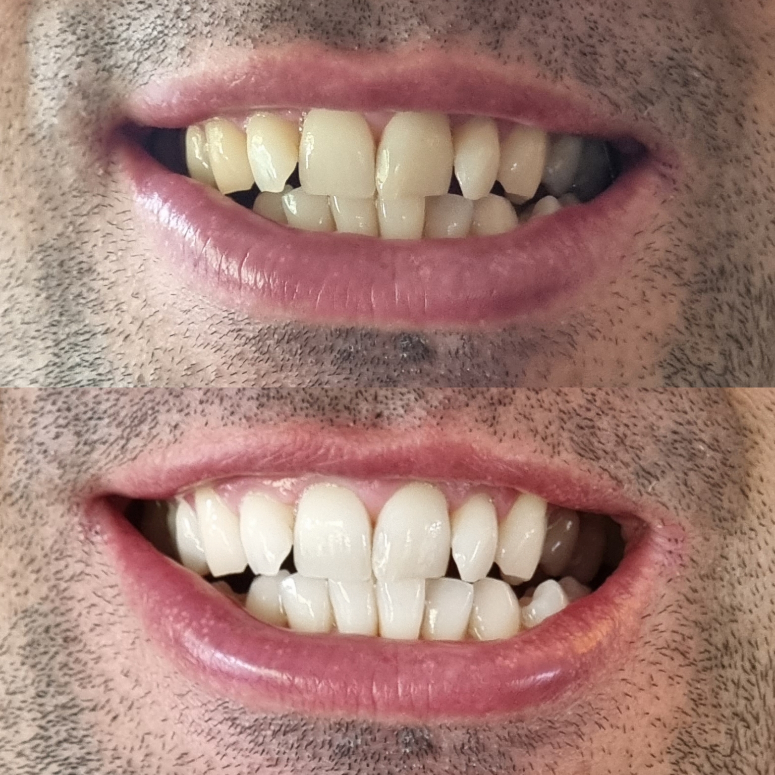 Teeth Bleaching Dentist in Melbourne Teeth Whitening Melbourne IssueWire