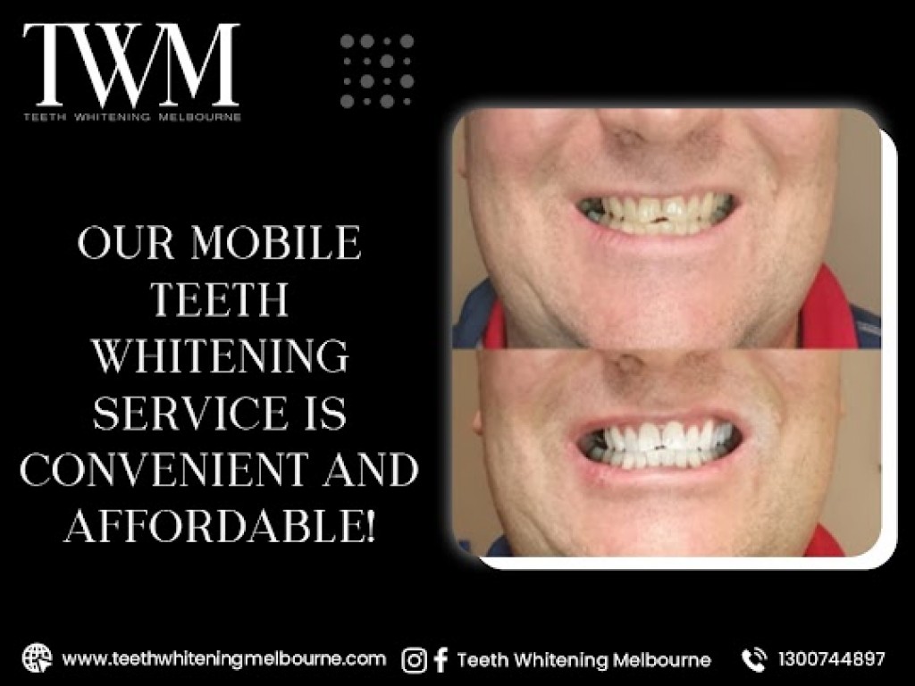 Mobile Teeth Whitening Melbourne IssueWire