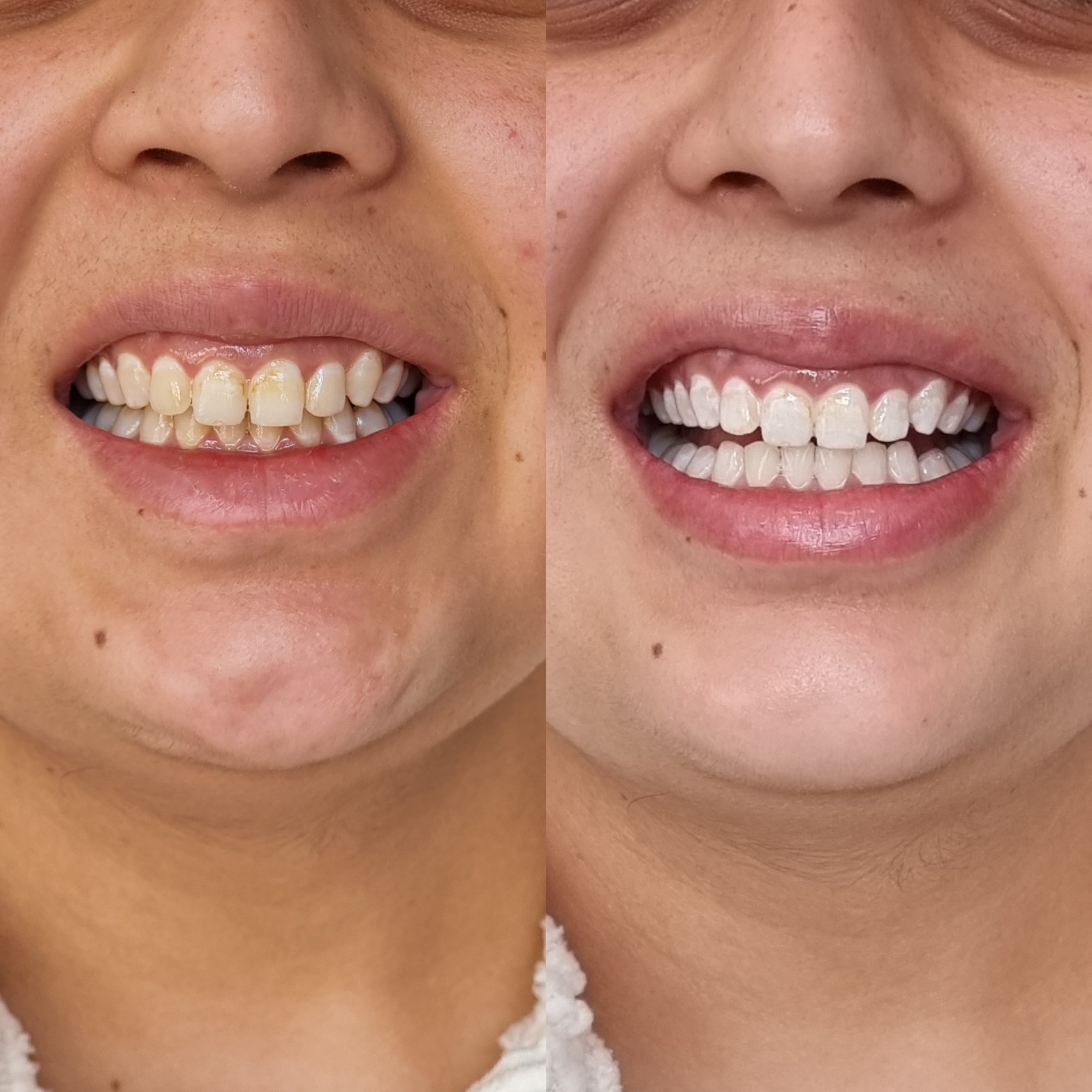 Mobile Teeth Whitening Melbourne IssueWire