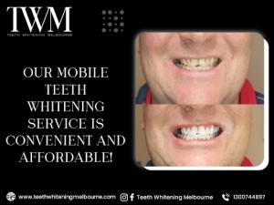 Mobile Teeth Whitening Melbourne