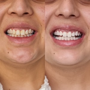Mobile Teeth Whitening Melbourne