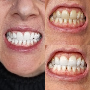Mobile Teeth Whitening Melbourne
