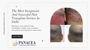 The Most Inexpensive And Successful Hair Transplant Services In Delhi