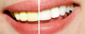 teeth whitening near me