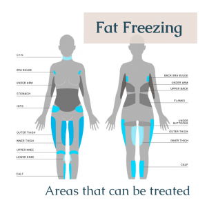Areas for fat freezing
