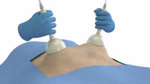 Lapovations Announces Distribution Agreement with Empire Surgical to Sell AbGrab® Across Florida