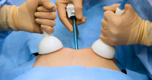 Lapovations Signs Distribution Agreement with Arkansas based VersaMed to Sell AbGrab® in Northwest Arkansas