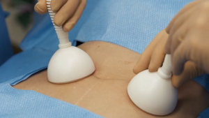 Lapovations Signs Distribution Agreement with Oregon based Edge Surgical to Sell AbGrab® Across 3 Northwest States