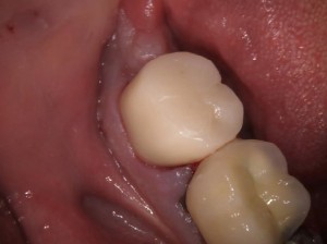 Abscess cleared one month after Root canal Treatment.