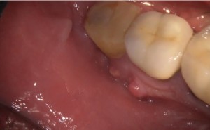 Abscess under the crown tooth needs root canal treatment.