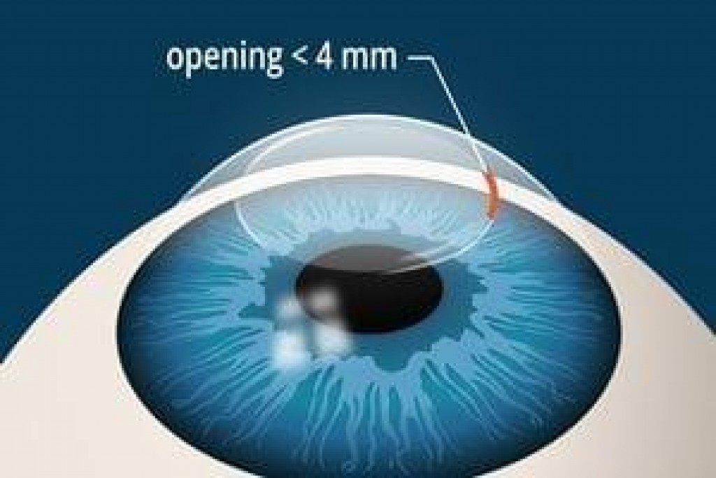 Understanding Laser Eye Surgery in Delhi IssueWire