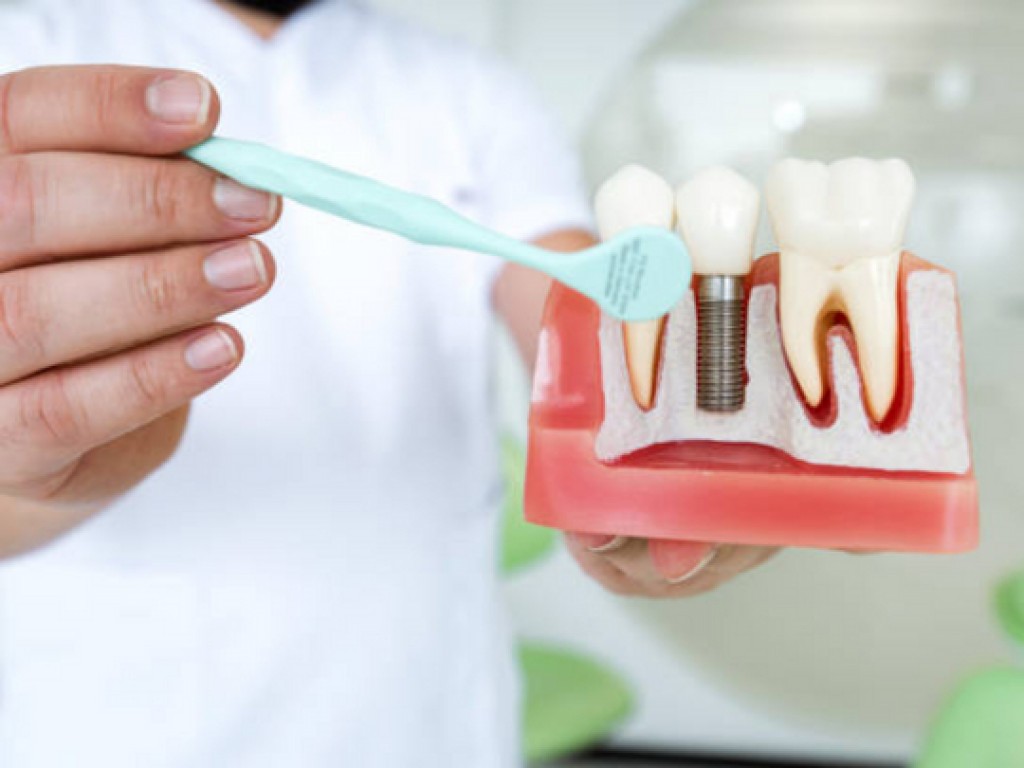 Get The Best Dental Implants In Alvin At Revive Dental IssueWire
