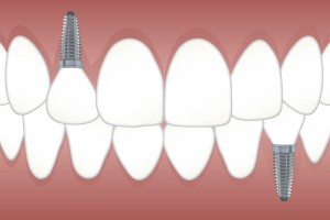 Dental implants near me